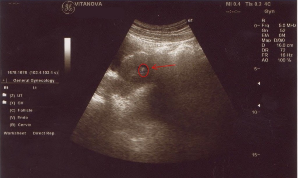 Transfer Embrioni..arriva il fatidico giorno! Inseminazione Assistita Transfer Embrioni..arriva il fatidico giorno! Inseminazione Assistita